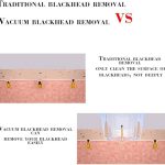 میکرودرم پاک کننده پوست Comedones (5)